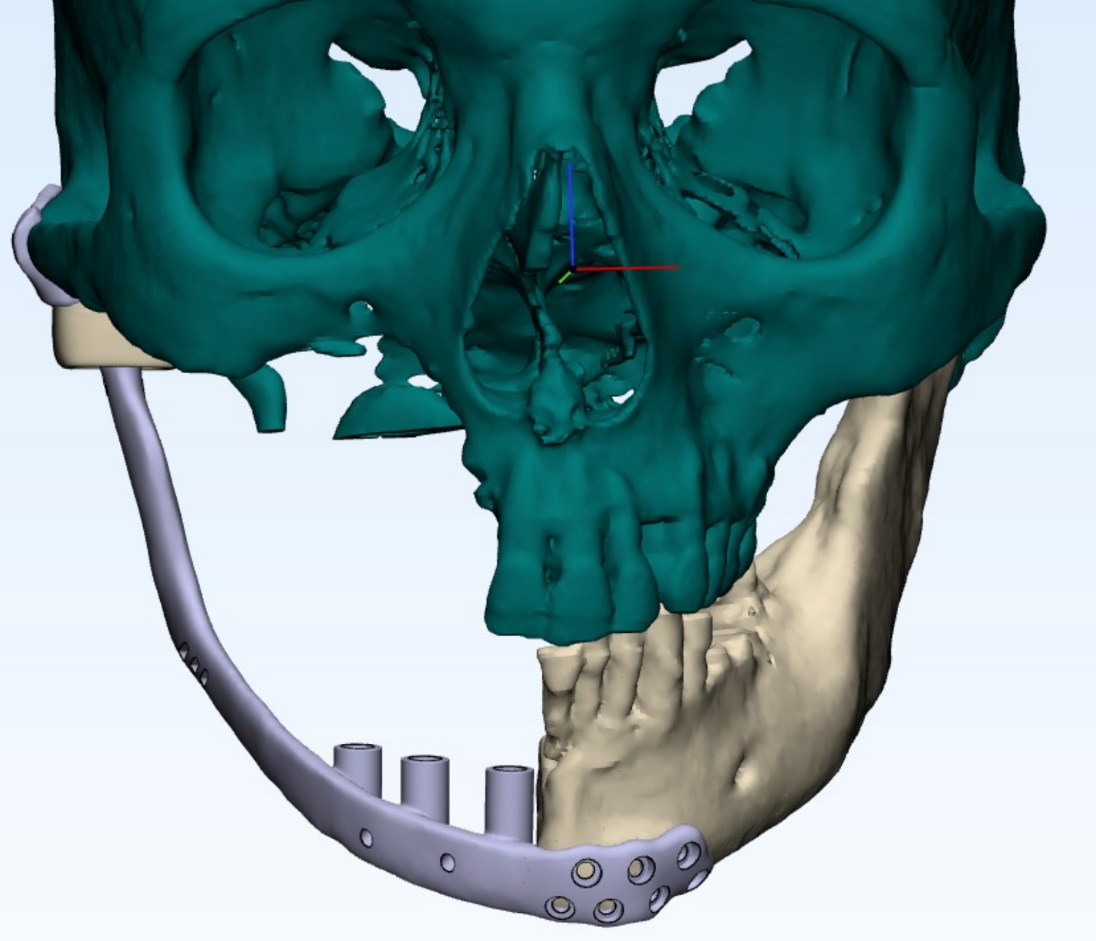 Patient-specific titanium implant designed to recreate the patient’s individual mandibulofacial anatomy.