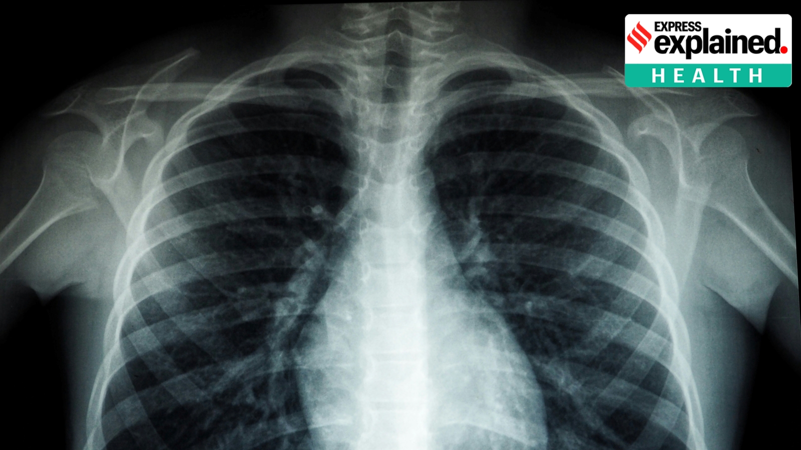 Explained: Why India’s rejection of a TB drug patent matters for patients