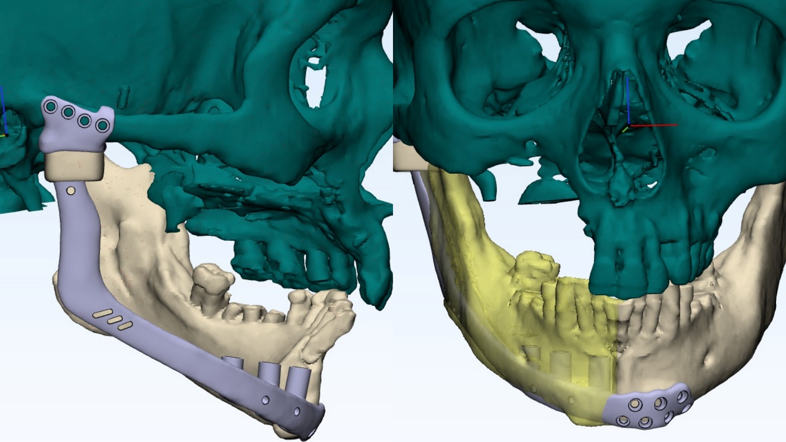 Cancer Survivor Turns to 3D Technology for Jaw Reconstruction