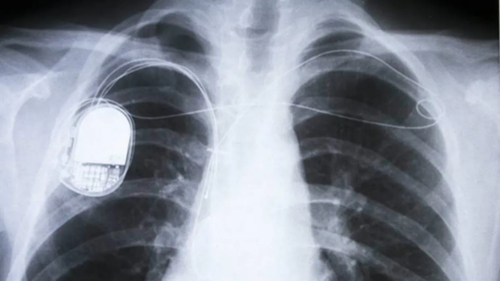 At 63, she needed a pacemaker, which got infected. What saved her? – national At 63, she needed a pacemaker, which got infected. What saved her? – national