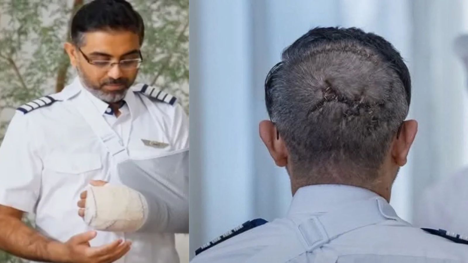 Stitches on head, flydubai Indian pilot Smit Machchhar in UAE draws attention